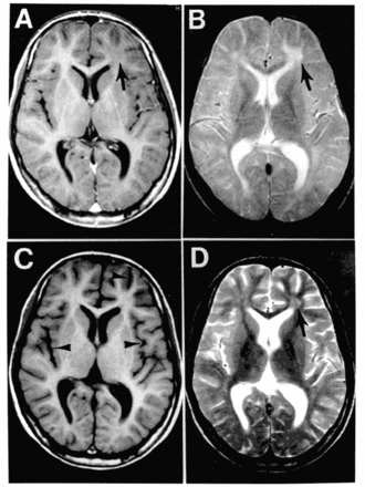 Subacute scleroserende panencefalitis