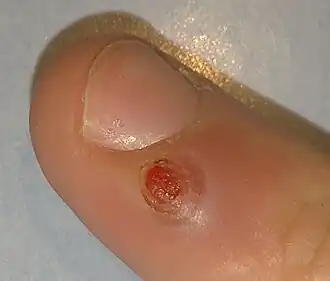 Granuloma teleangiectaticum