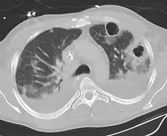 CT Thorax - beeld van pneumonie met verscheidene longabcessen, 2 cavernes en effusies dorsaal en rond de cavernes