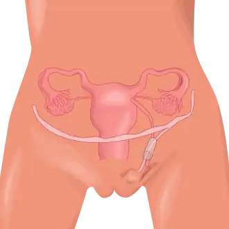 Gang van Nuck en het ligamentum rotundum uteri (ronde ligament) door het lieskanaal