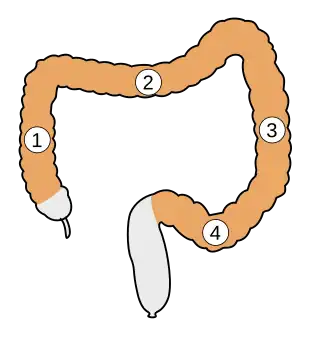 alt=Schematische voorstelling van de onderdelen van de karteldarm: 1. Colon ascendens 2. Colon transversum 3. Colon descendens 4. Colon sigmoideum