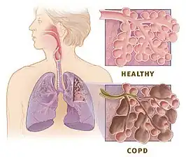 COPD in vergelijking met een gezonde long (healthy)