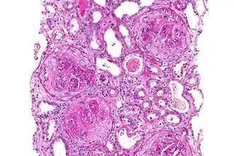 Syndroom van Goodpasture