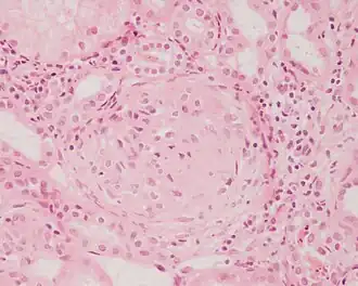 Glomerulonefritis