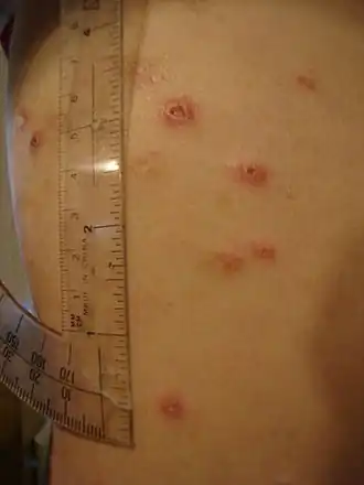 Huidzweren bij een patiënt met de ziekte van Crohn