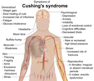 Syndroom van Cushing
