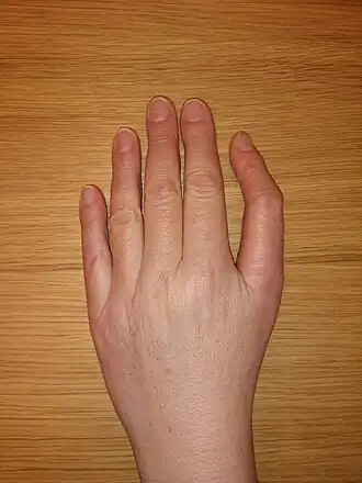 Diamond-Blackfan-anemie