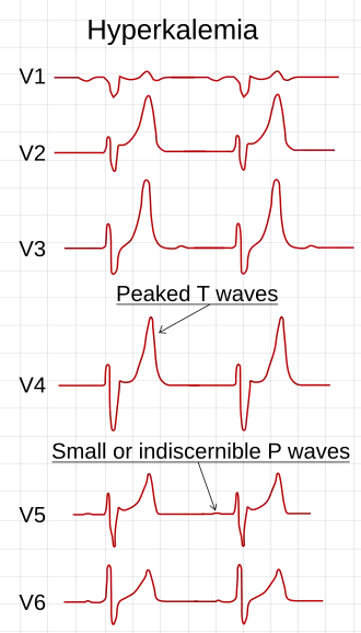 Het ECG-patroon bij hyperkaliëmie.