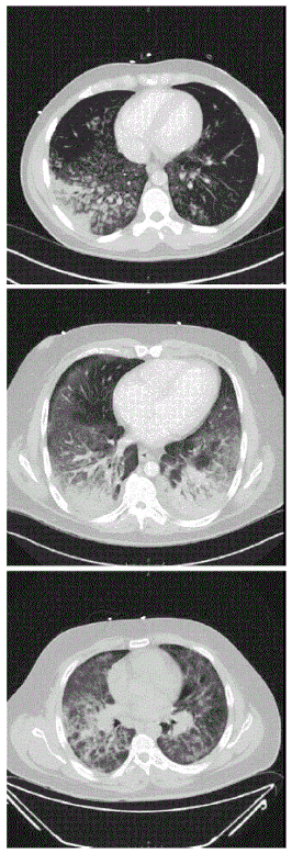 CT-scans tonen diffuse longinfiltraten bij drie patiënten met een ernstige vorm van vaping-gerelateerde longschade.