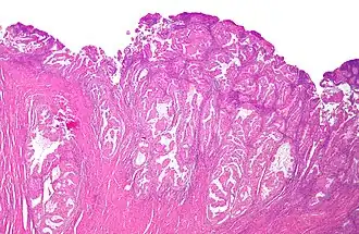 Histologisch preparaat van endometriaal adenocarcinoom, de meest voorkomende vorm van baarmoederkanker, gekleurd met hematoxyline en eosine.