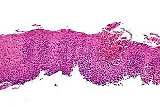 Infiltratie van het slokdarmslijmvlies met eosinofiele granulocyten