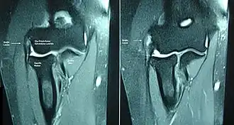 Epicondylitis lateralis