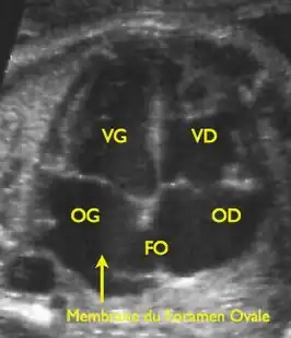 {VG: linker ventricel, VD: rechter ventrikel, OG: linkeratrium, OD: rechteratrium, FO: foramen ovale