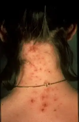 Pediculosis