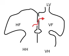 Bloed, weergegeven met de rode pijl, stroomt door het foramen ovale en het foramen secundum. HH: rechterventrikel, VH: linkerventrikel, HF: rechteratrium, VF: linkeratrium, LV: longader