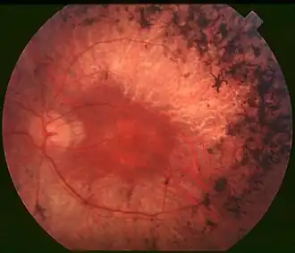 Retinitis pigmentosa