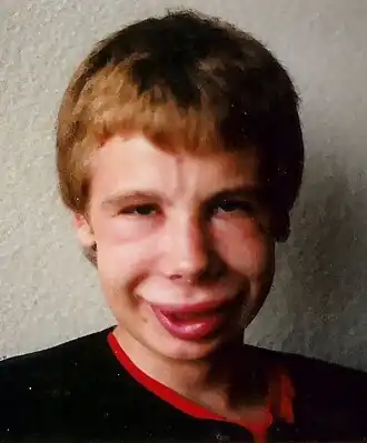 Angio-oedeem in het gezicht