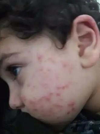 Syndroom van Gianotti-Crosti