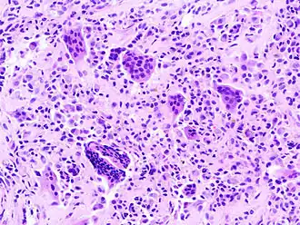 Histopathologie van PVNS