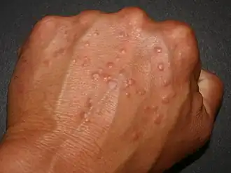 Granuloma anulare op de hand