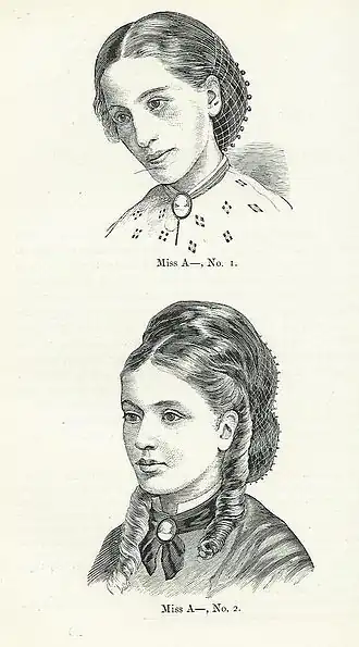 "Miss A-" afgebeeld in 1866 en in 1870 na de behandeling. Uit de gepubliceerde medische papieren van Sir William Gull
