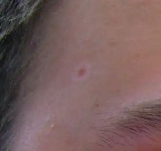 Halonaevus op het gezicht.