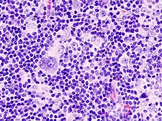 Biopt van lymfeknoop met hodgkinlymfoom (gemengdcellig type, H&E-kleuring)