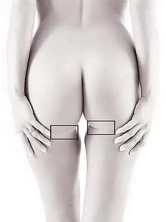 Beide sulci zijn aangegeven met een kader.