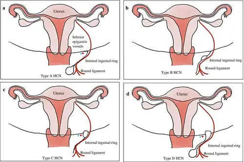 Typen hydrocelen. Inquinal ring = Lieskanaal. Round ligament = ligamentum rotundum uteri (ronde ligament)