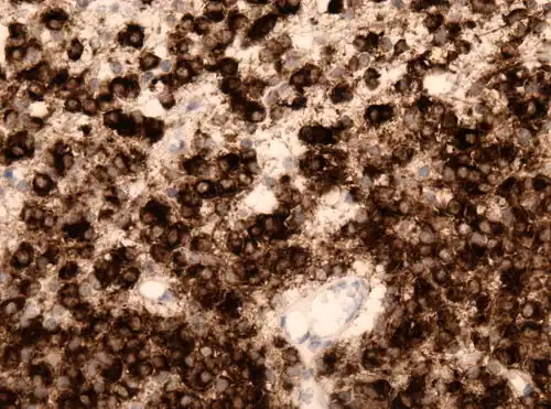 IDH1 R132H bij anaplastisch oligodendroglioom