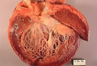 Cardiomyopathie