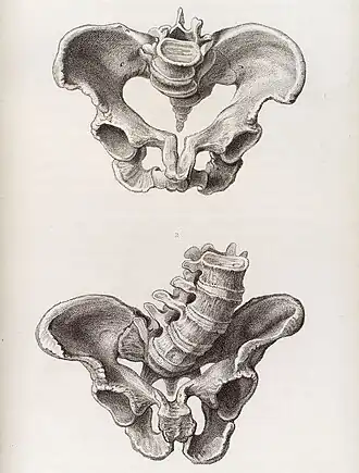 Afwijkende vorm van het bekken, een risicofactor voor een obstructie tijdens de bevalling