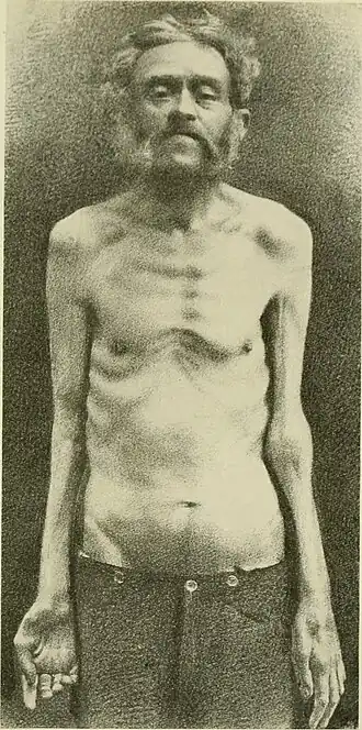 Oudere man met zichtbare atrofie van de skeletspieren in een gevorderd stadium in het gehele bewegingsapparaat.