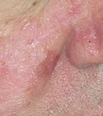 Melanoma in situ