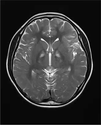 Syndroom van Kearns-Sayre