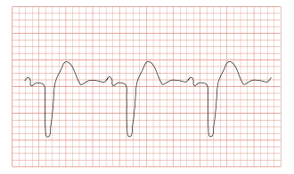 ECG met een bundeltakblok