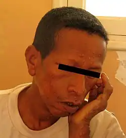 Lepromateuze lepra-patiënt (Madagaskar)