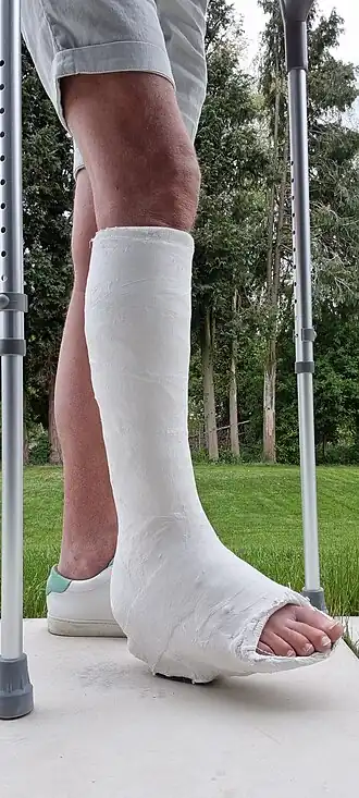 Plaster of Paris walking cast with toeplate and heel