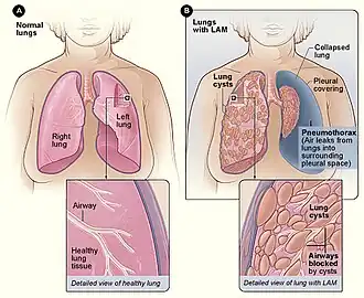 Figuur A laat de locatie zien van de longen en luchtwegen in het lichaam. De vergroting laat een doorsnede zien van een gezonde long. Figuur B laat longen zin met LAM en een klaplong (pneumothorax). De vergroting laat een doorsnede zien van een long met LAM.