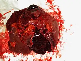 Gescheurde milt als gevolg van trauma