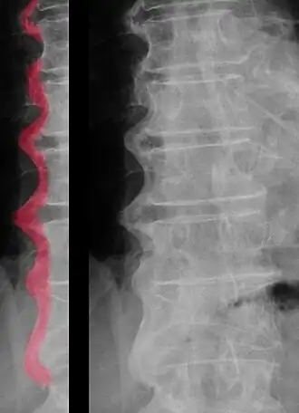 Röntgenfoto van de wervelkolom (thoracaal/lumbaal) met de ziekte van Forestier. Duidelijk is te zien dat de wervels aan elkaar zijn vastgegroeid in een golvend patroon.[1]