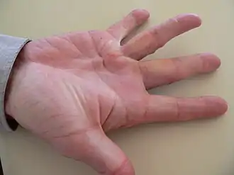 Contractuur van Dupuytren aan de ringvinger