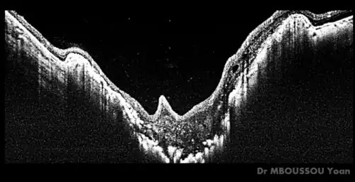 Morning glory syndrom met optische coherentietomografie (OCT)