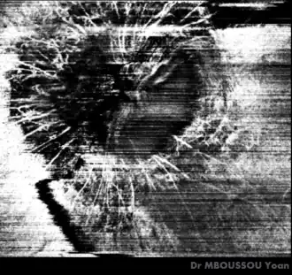 Morning glory syndrom met optische coherentietomografie angiografie (OCTA)