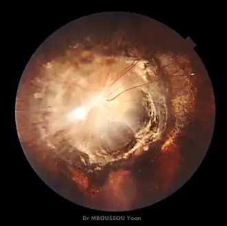 Morning glory syndroom