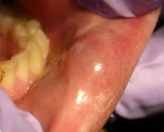 mucocele op de onderlip