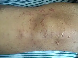 Huidafwijkingen aan de knie bij een 52-jarige patiënt met mycosis fungoides