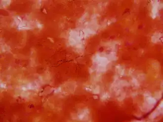 Nocardia in een hersenbiopsie