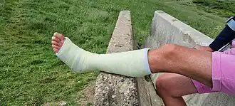 White synthetic short leg cast with traces of usage