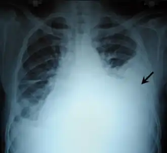 Hemothorax, aangegeven met pijl